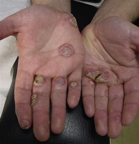 Syphilis - a plantar problem