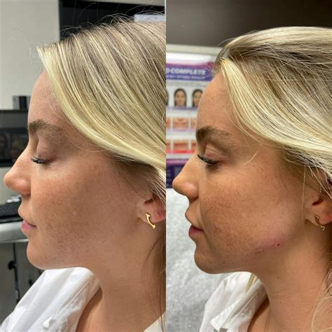 Jawline Augmentation Gallery Before & After Photos | Laser Cliniqúe