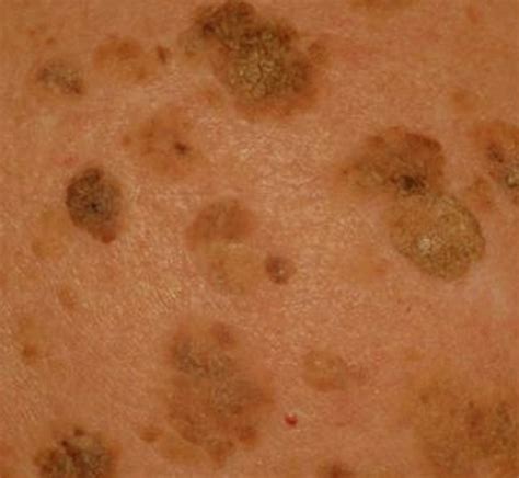 Seborrheic Keratosis Symptoms Treatment And Causes - vrogue.co