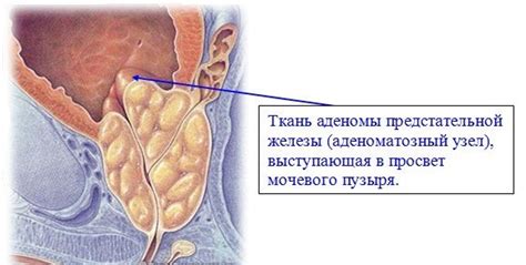 Что такое «Увеличение предстательной железы» - глоссарий портала ...