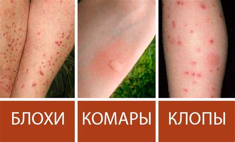 Как выглядят укусы клопов на коже человека фото