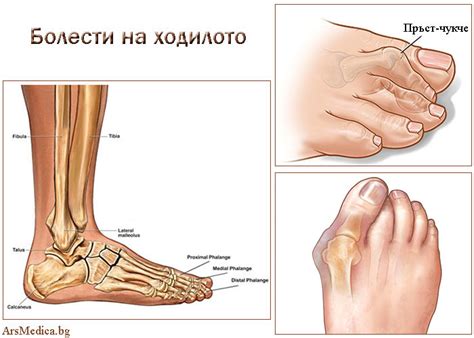 Болести на ходилото - 1-ва част - ArsMedica.bg | Okay gesture