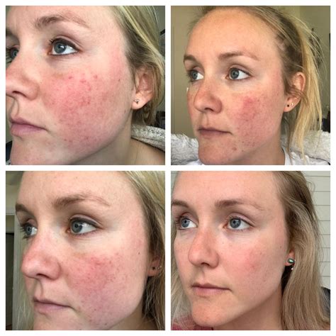 Acne Rosacea Before After