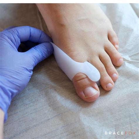 Hallux Valgus: Oorzaken, Symptomen, Behandeling en Aanbevolen Braces ...
