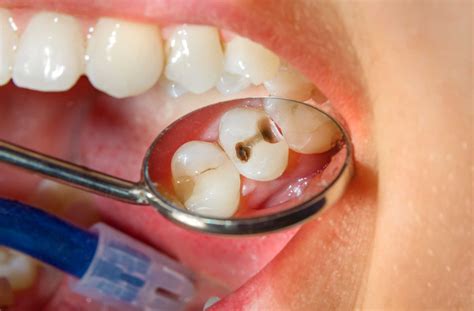 how to tell if you have a cavity at home
