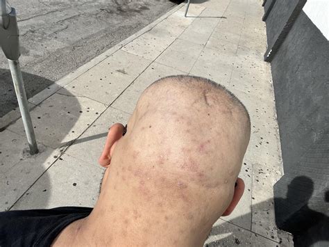 Acne Scalp Scars : r/Skincare_Addiction