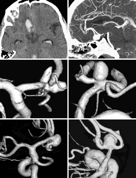 Anterior Communicating Artery Aneurysm | The Neurosurgical Atlas