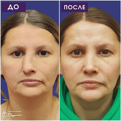 Ринопластика, пластика носа цена и отзывы в Калининграде