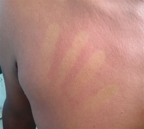 Dengue Rash