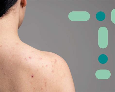 Qual o motivo das espinhas pelo corpo? Entenda!
