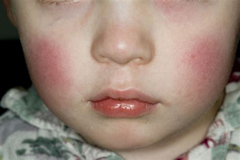 What to know about the 'slapped cheek' virus uptick in the U.S. | NPR