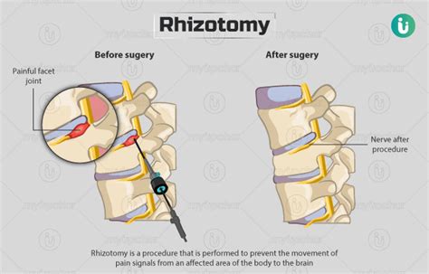 Rhizotomy: Procedure, Purpose, Results, Cost, Price, Indications, Recovery