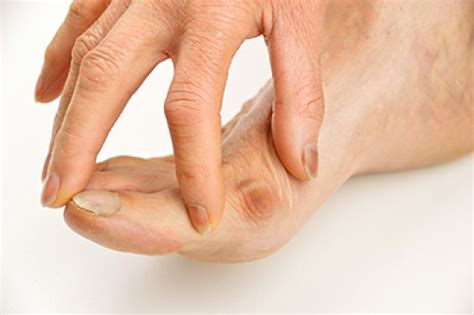 What Are Bunions? - Blog