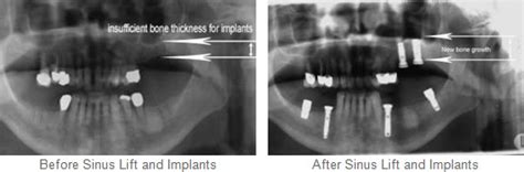 Sinus Lift Manhattan - NYC Implant Procedures