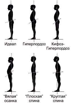 Искривление позвоночника » Клиника Доктора Игнатьева