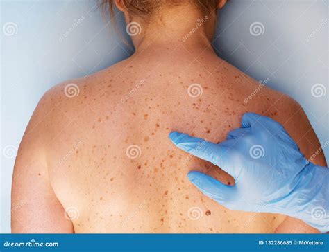 Mole On The Skin Of The Body. Birthmark. Acrochordon Stock Photo ...