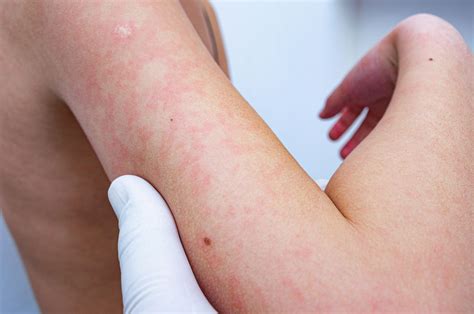 Heat Rash/Prickly Heat Types, Causes, Symptoms, Diagnosis,, 48% OFF
