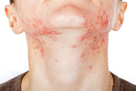 Hormonal Acne: What It Is, Causes, Treatments and Remedies