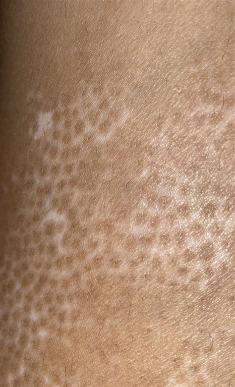 Opzelura success : r/Vitiligo