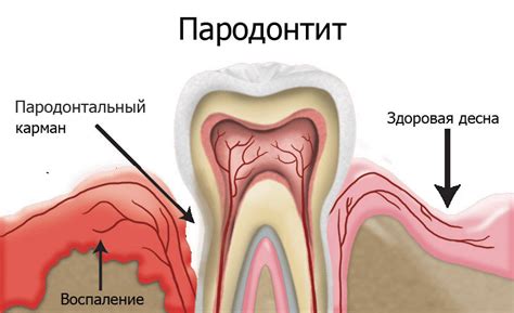 Имплантация зубов при пародонтите и пародонтозе: цены, технологии ...