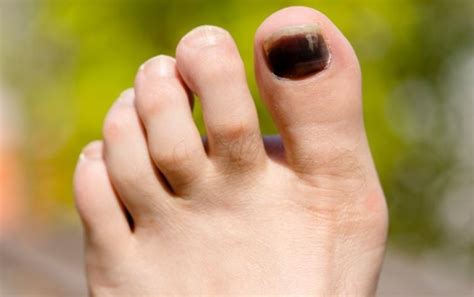 Runner's Toe: Causes, Symptoms, And Prevention