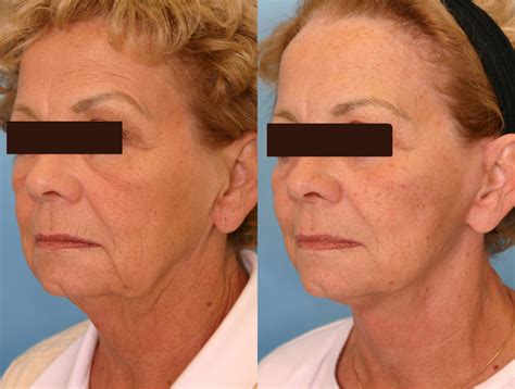 What Really Happened? Jen Psaki's Plastic Surgery Mystery Solved Image 9