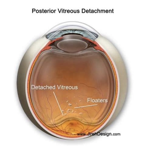 Eye Health Alert: PVD and Retinal Detachment