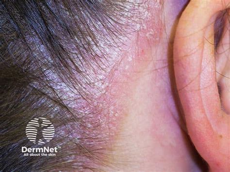 mild psoriasis  scalp treatment