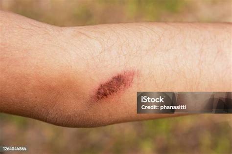 luka closeup  latar belakang siku anak mendapatkan luka segar