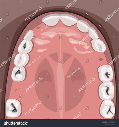 Vector Stock Illustration Caries Teeth On Stock Vector (Royalty Free