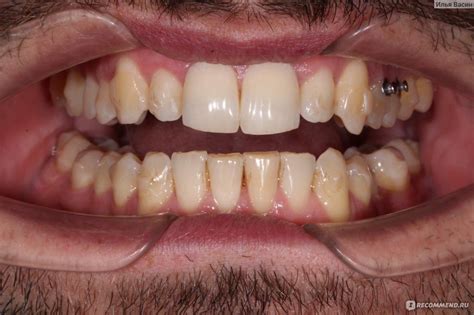 Элайнеры - «Элайнеры CLICK Aligners» | отзывы