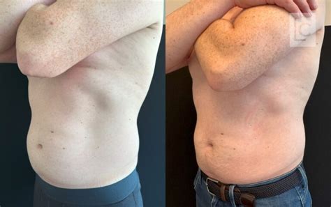 Coolsculpting Antes E Depois - Coolsculpting Antes e Depois