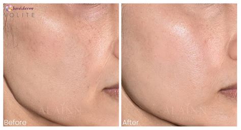 skin booster injection  alainn clinic petaling jaya kuala lumpur