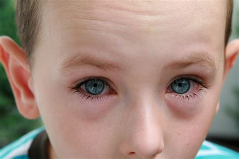 Birch Pollen and Allergy | Allergy UK | National Charity