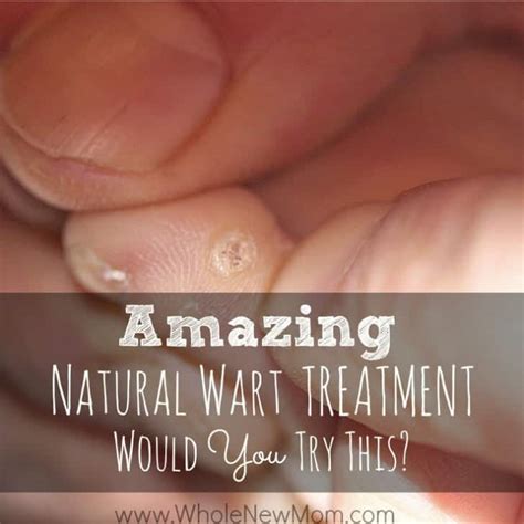 16 Natural Remedies for Warts-Plus a Truly Crazy One!
