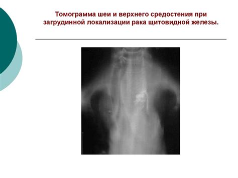 Рак щитовидной железы - презентация онлайн
