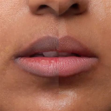 All About Laser Lip Lightening: Effects, Cost, Risks