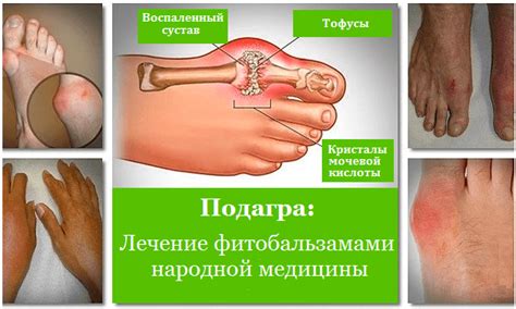 Подагрин-Подагра болезнь отложения кристаллов уратов в суставах и ...