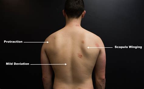 Winged Scapula and Shoulder Pain [Case Study] — ONI | Wellington