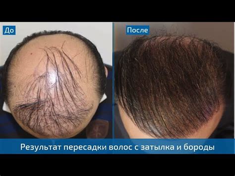 Результаты пересадки волос - Видео до и после - Клиника HLC