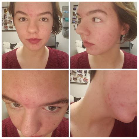 Many Viewers Find The Educational Videos Of Blackheads And Cysts Helpful For Understanding Various Common Skin Health Conditions 9