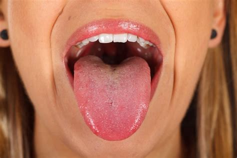 Deficiencia De B12 Lingua - Vitamin B12 Deficiency Symptoms Tongue