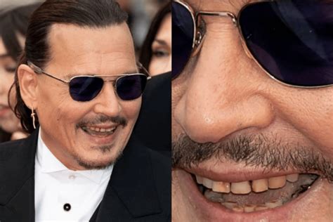 Johnny Depp Teeth Fixed