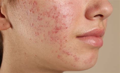 How To Get Rid Of Teenage Acne | allmedic