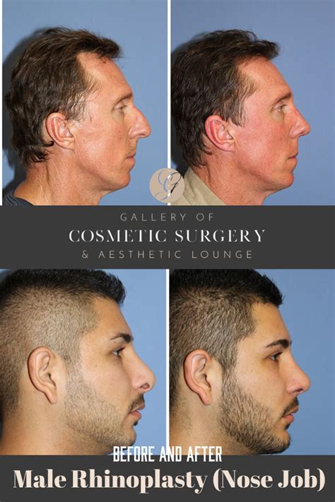 nose contouring nose reshaping rhinoplasty nose jobs rhinoplasty