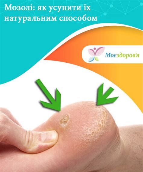 Мозолі: натуральний спосіб від неприємного дискомфорту