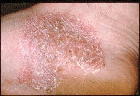 Psoriasis and psoriatic arthritis on the feet