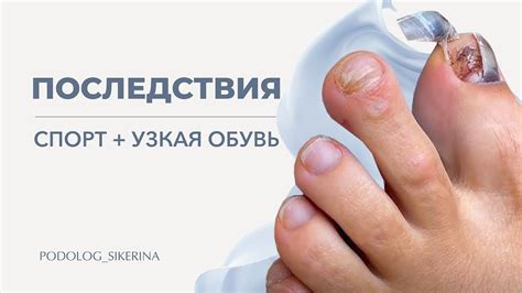 ОТДАВИЛА ПАЛЬЦЫ ОБУВЬЮ 😱НОГОТЬ ОТОШЁЛ ОТ ЛОЖА - YouTube