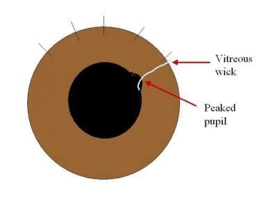 Ruptured Globe Peaked Pupil
