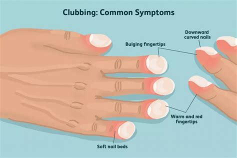 Pulmonary Fibrosis: Symptoms, Diagnosis, and Treatment